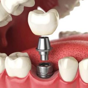 Prótesis dentales Prótesis dentales