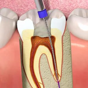 Endodoncia Endodoncia