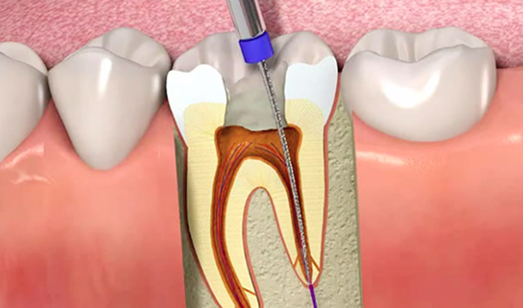 Endodoncia Endodoncia